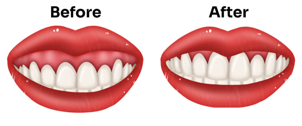 Gum contouring before after