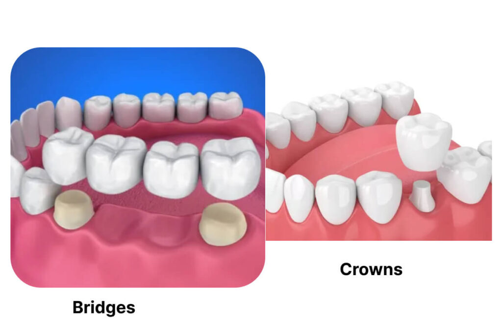 Bridges and Crown Treatment