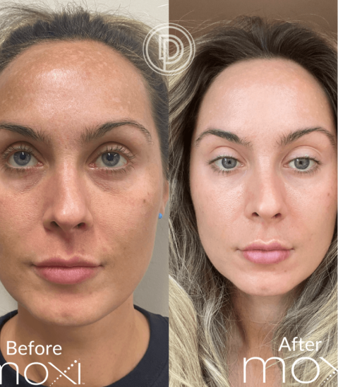 Side-by-side before and after images of a woman showing clearer, smoother skin and brighter complexion after treatment.