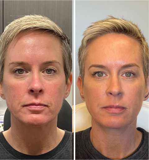 Side-by-side comparison of a woman with short blonde hair showing a before image with visible skin redness and uneven tone and an after image with clearer, smoother, and more even skin tone.