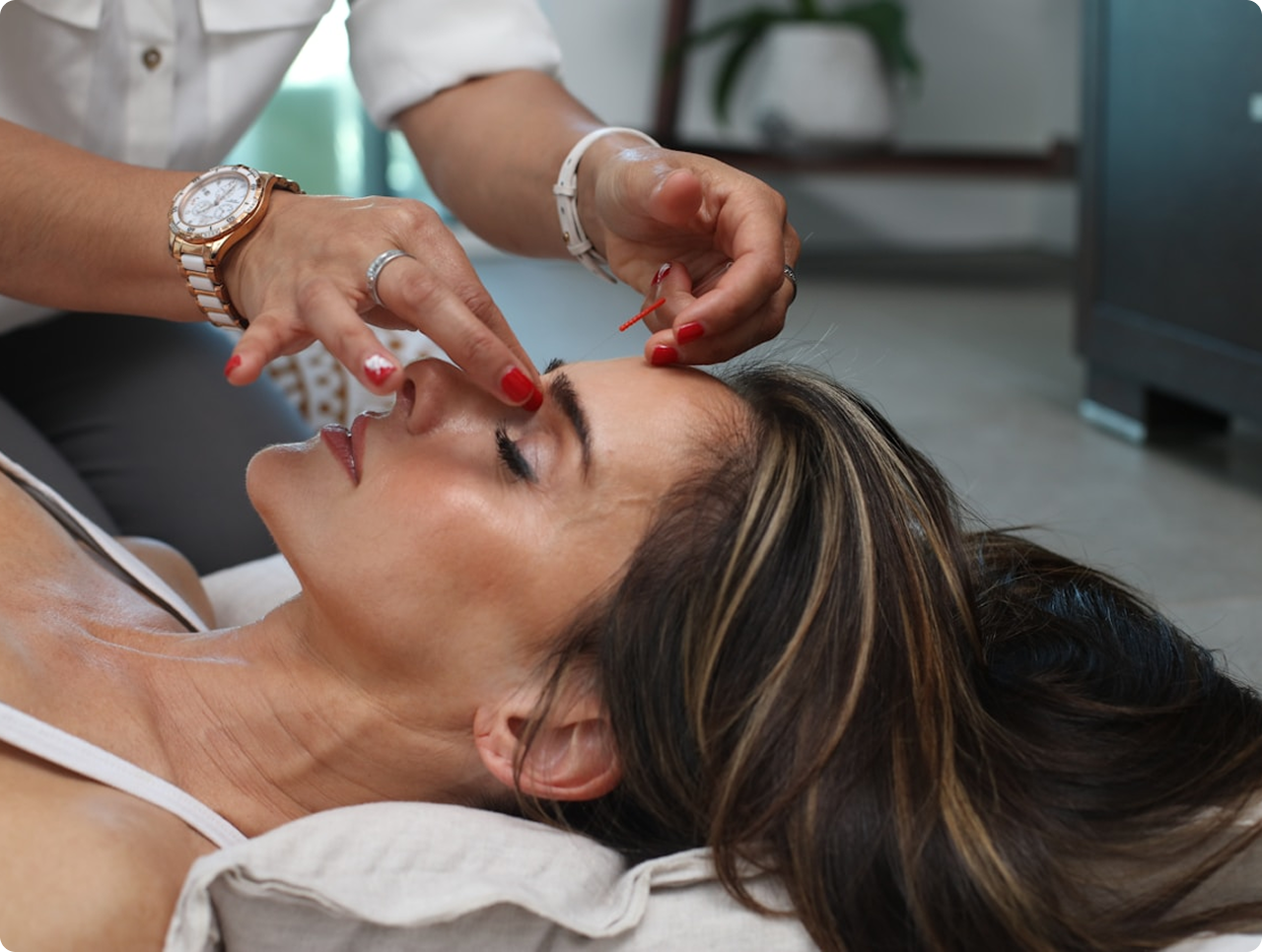 Close-up of a woman lying down receiving acupuncture treatment on her forehead with fine needles.