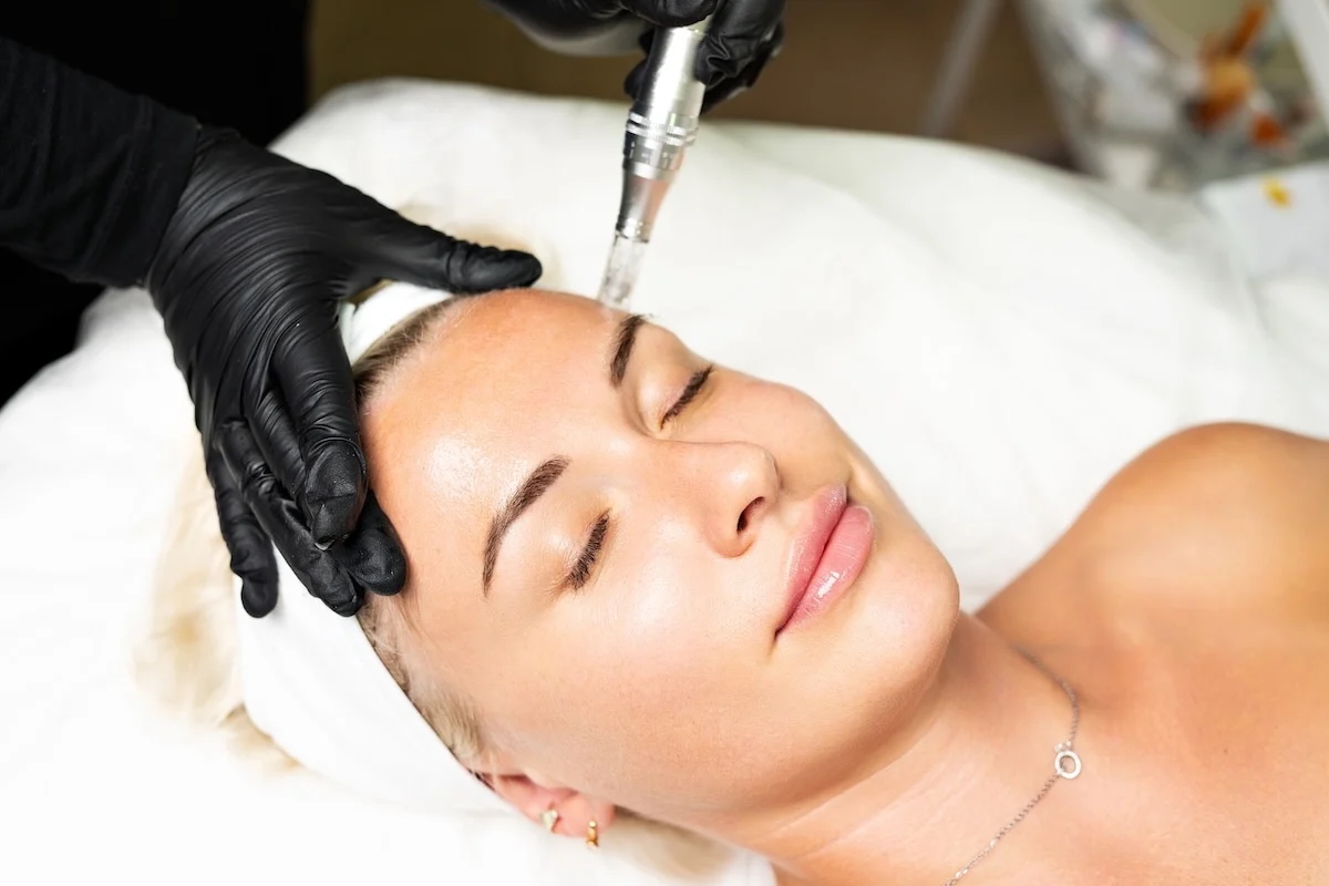 Woman receiving microneedling skin treatment on forehead by professional wearing black gloves.