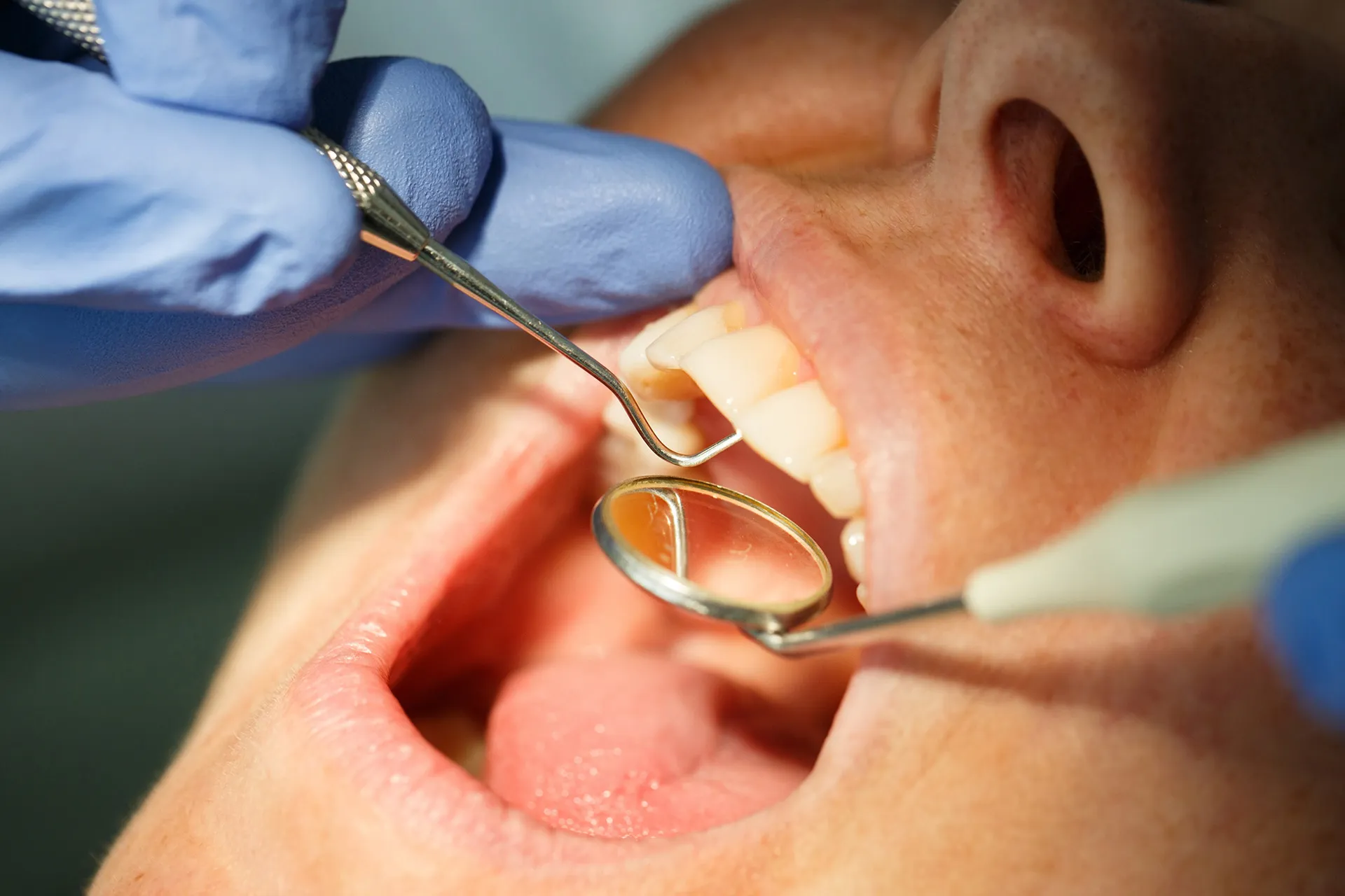Periodontal Maintenance