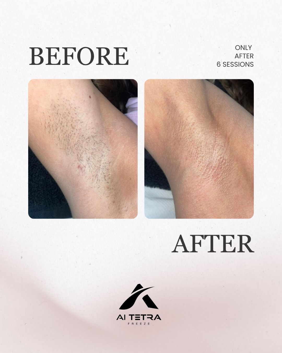 Arm hair removal — before and after six sessions