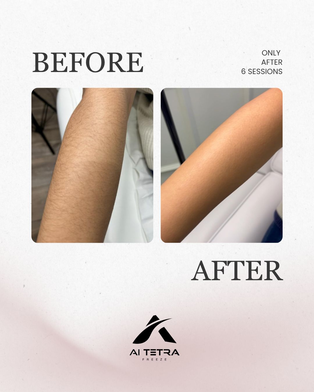 Chest and back hair removal — before and after six sessions