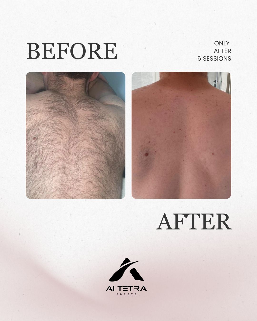 Underarm hair removal — before and after six sessions