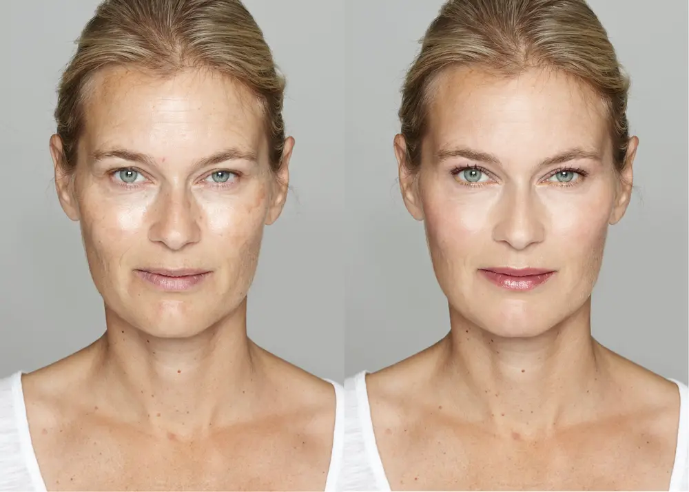 taches brunes et pigmentaires aux centres laser murano