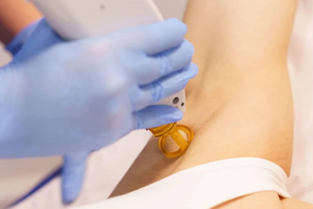 Épilaion laser des Aisselles aux centres laser murano