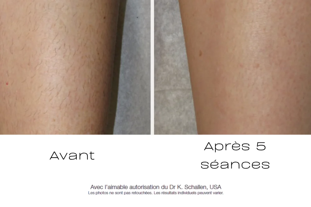 epilation laser candela avec le gentle max pro plus, photo avant/aprÃ¨s aux centres laser murano - blog