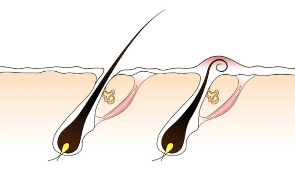 Poils incarnés - Comment les traiter - Centre Laser Murano