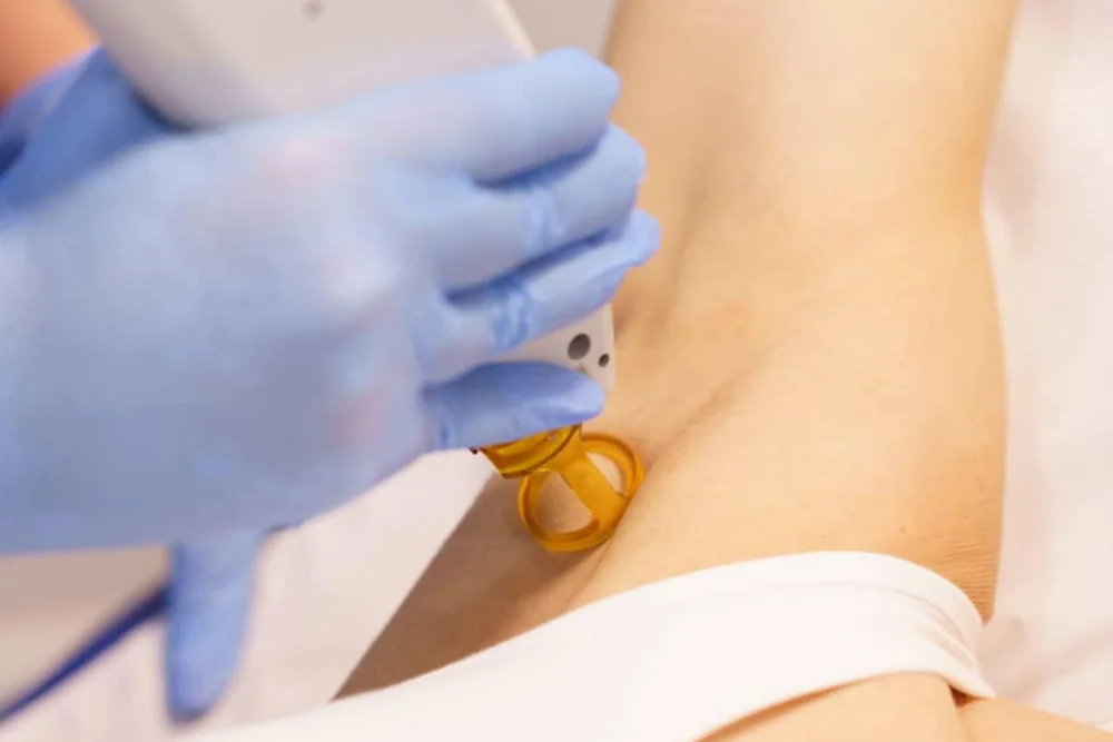 Épilation Laser - Guide Complet 2024