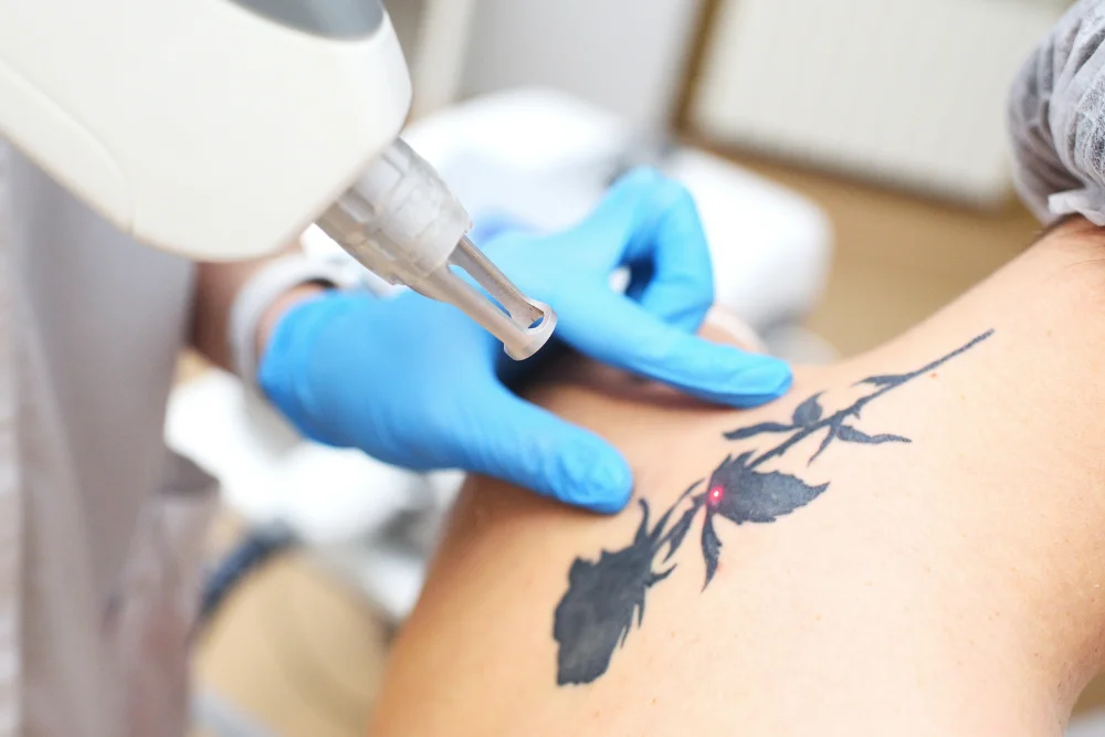 Le Détatouage au laser aux Centres Laser Murano