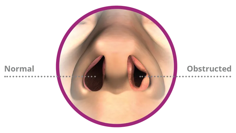 Nasal Obstruction treatment in Newnan and Peachtree City