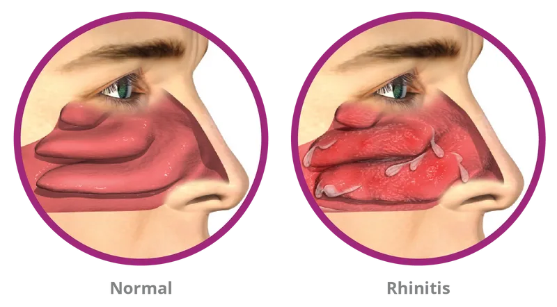 Rhinitis treatment in Peachtree City, Newnan & LaGrange