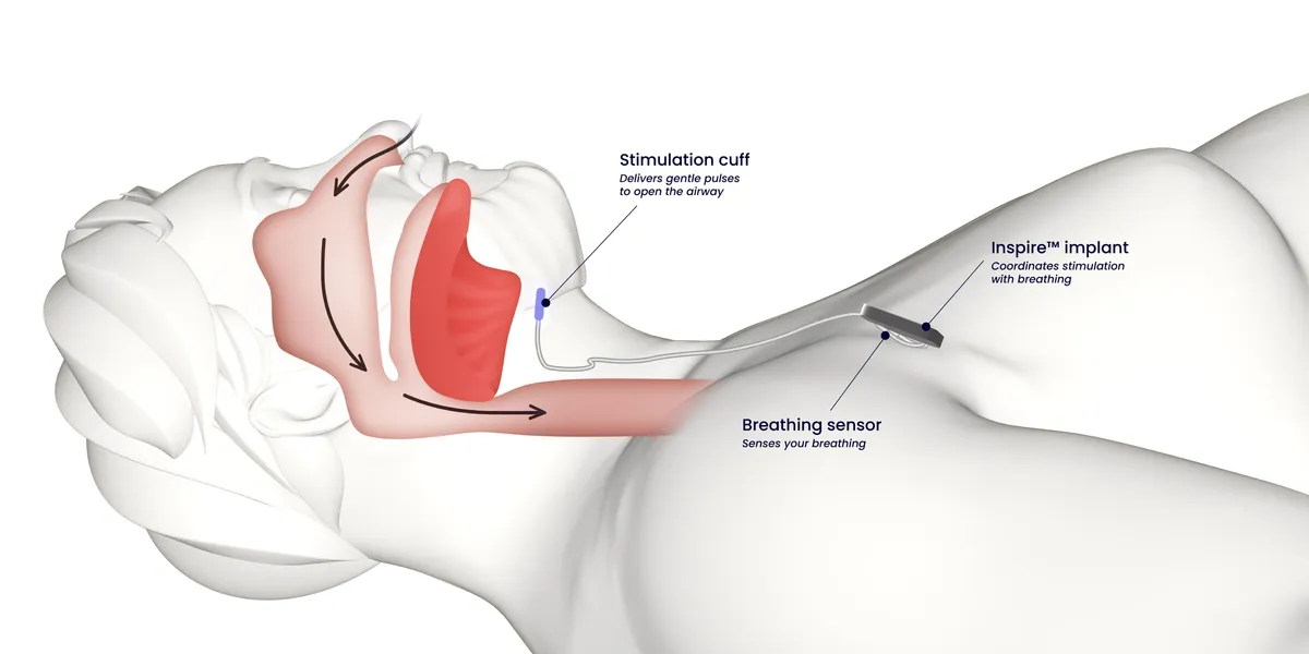 Obstructive sleep apnea treatment