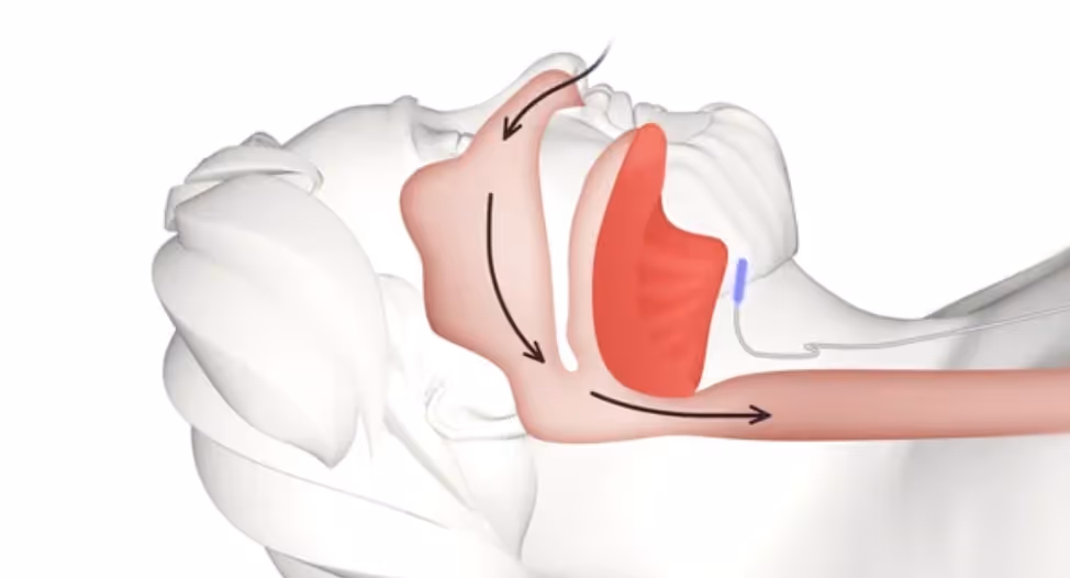 Obstructive sleep apnea treatment