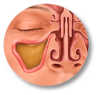 Balloon Sinuplasty Procedure Before