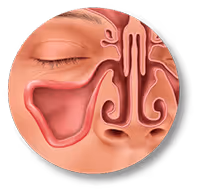 Balloon Sinuplasty Procedure After