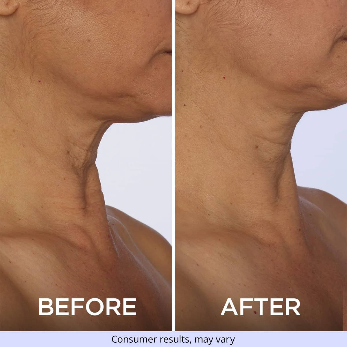 Side-by-side comparison of a person's neck before and after treatment, showing reduced wrinkles and smoother skin after.