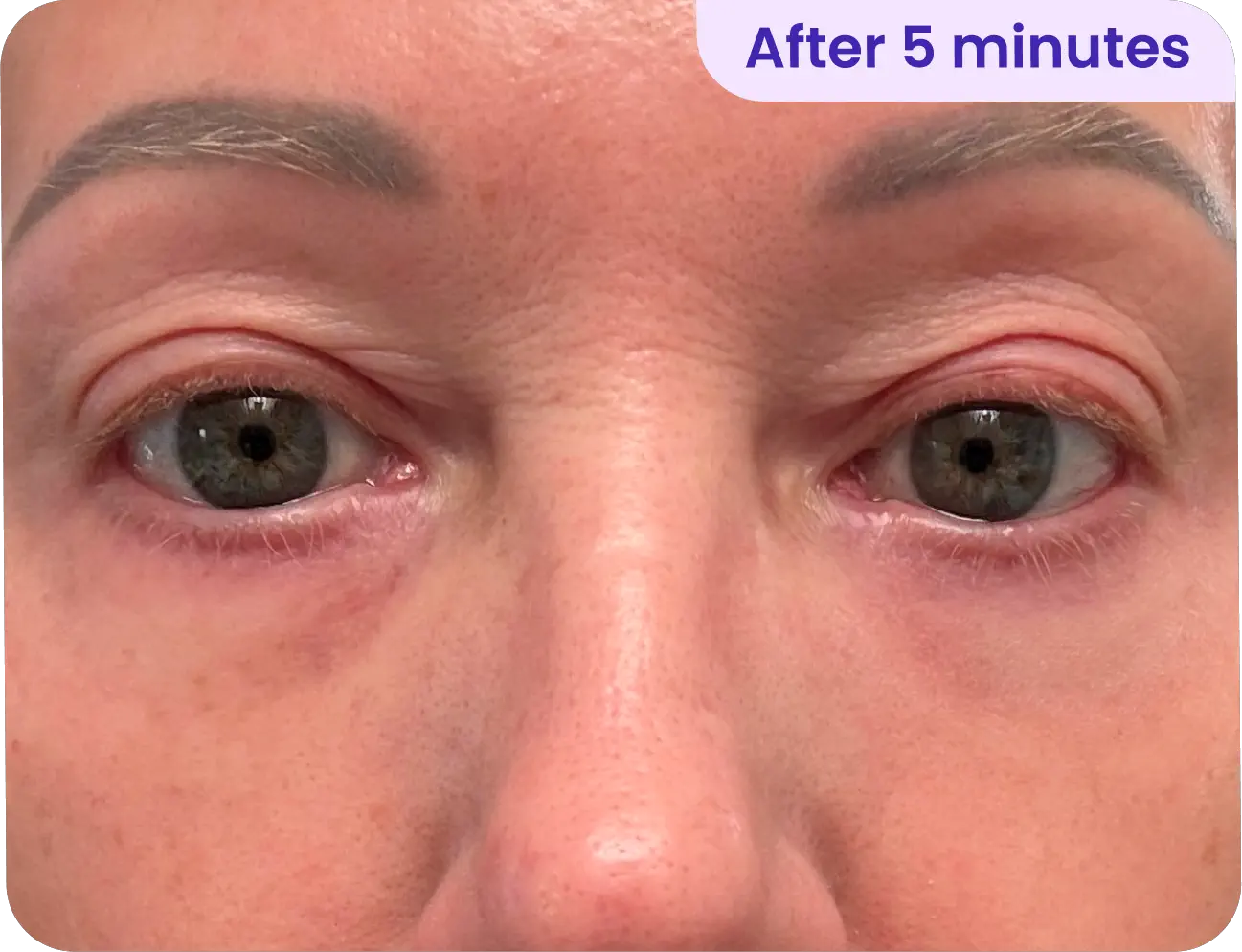 After using Insideefy Lift Eye Gel