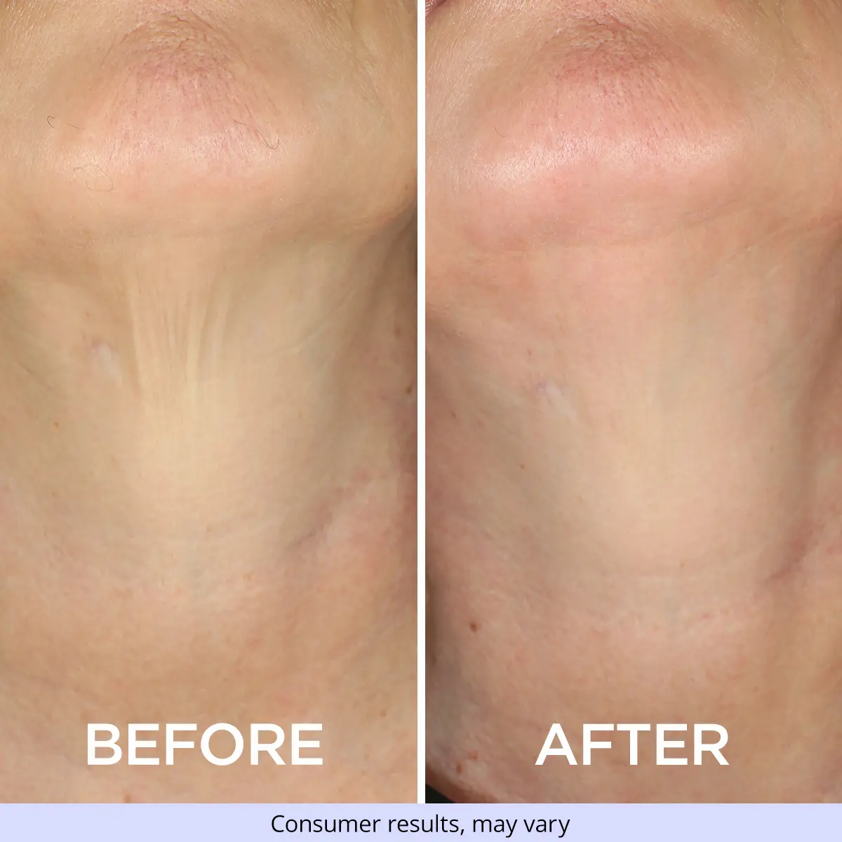 Before and after results