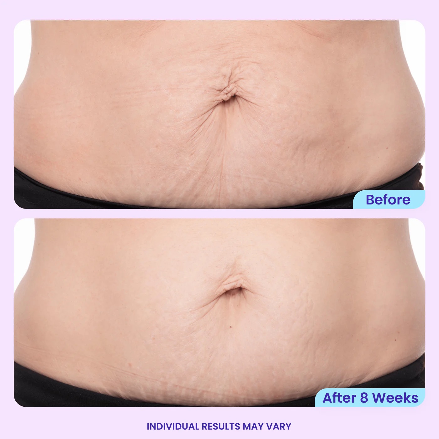 Belly skin before and after results