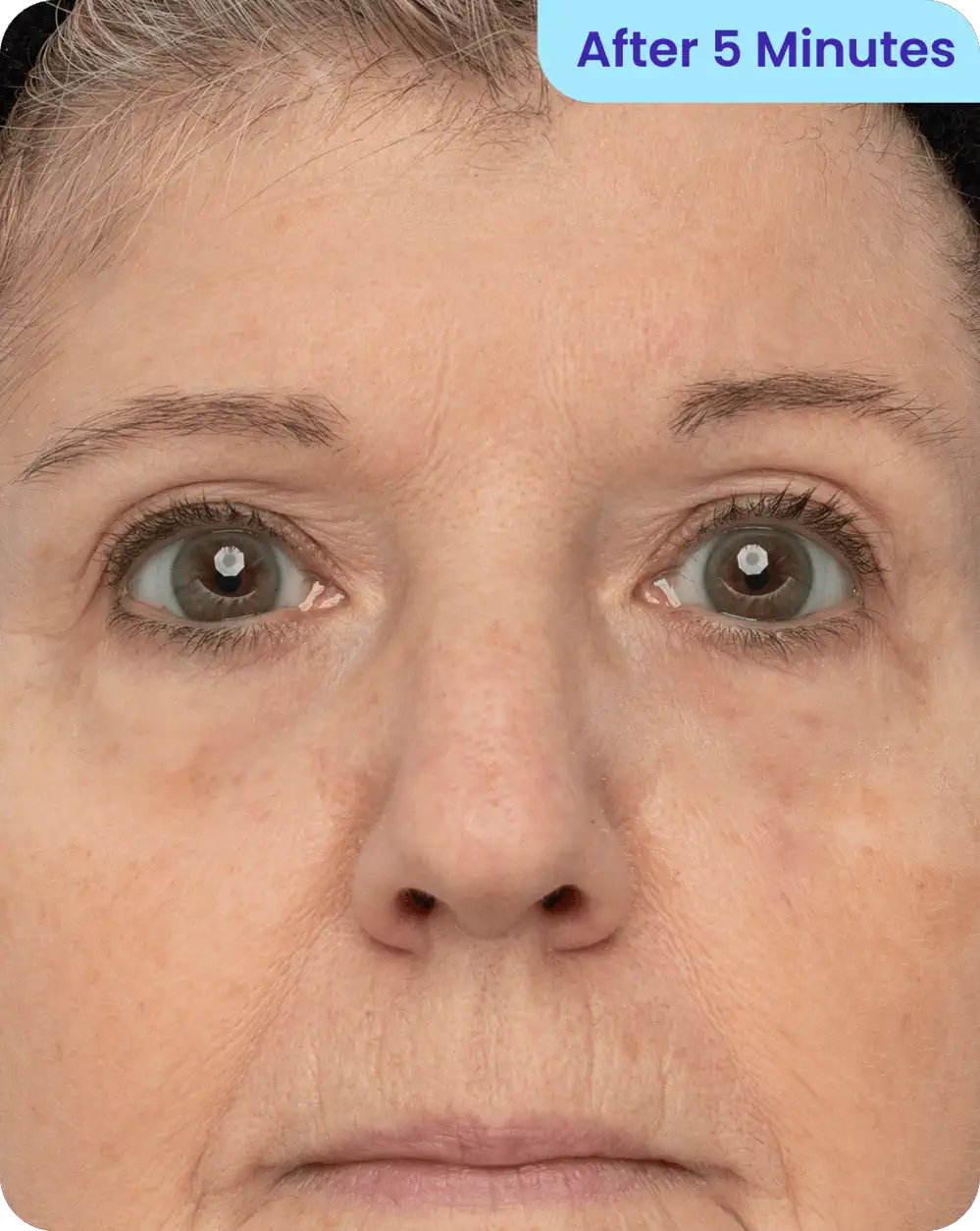 Skin appearance after 5 minutes