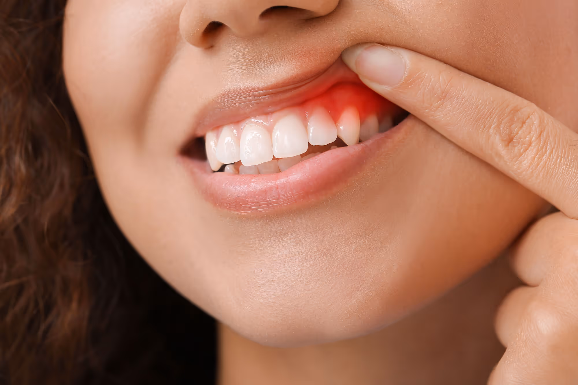 Close-up of a person pointing to red, inflamed gums on upper front teeth.