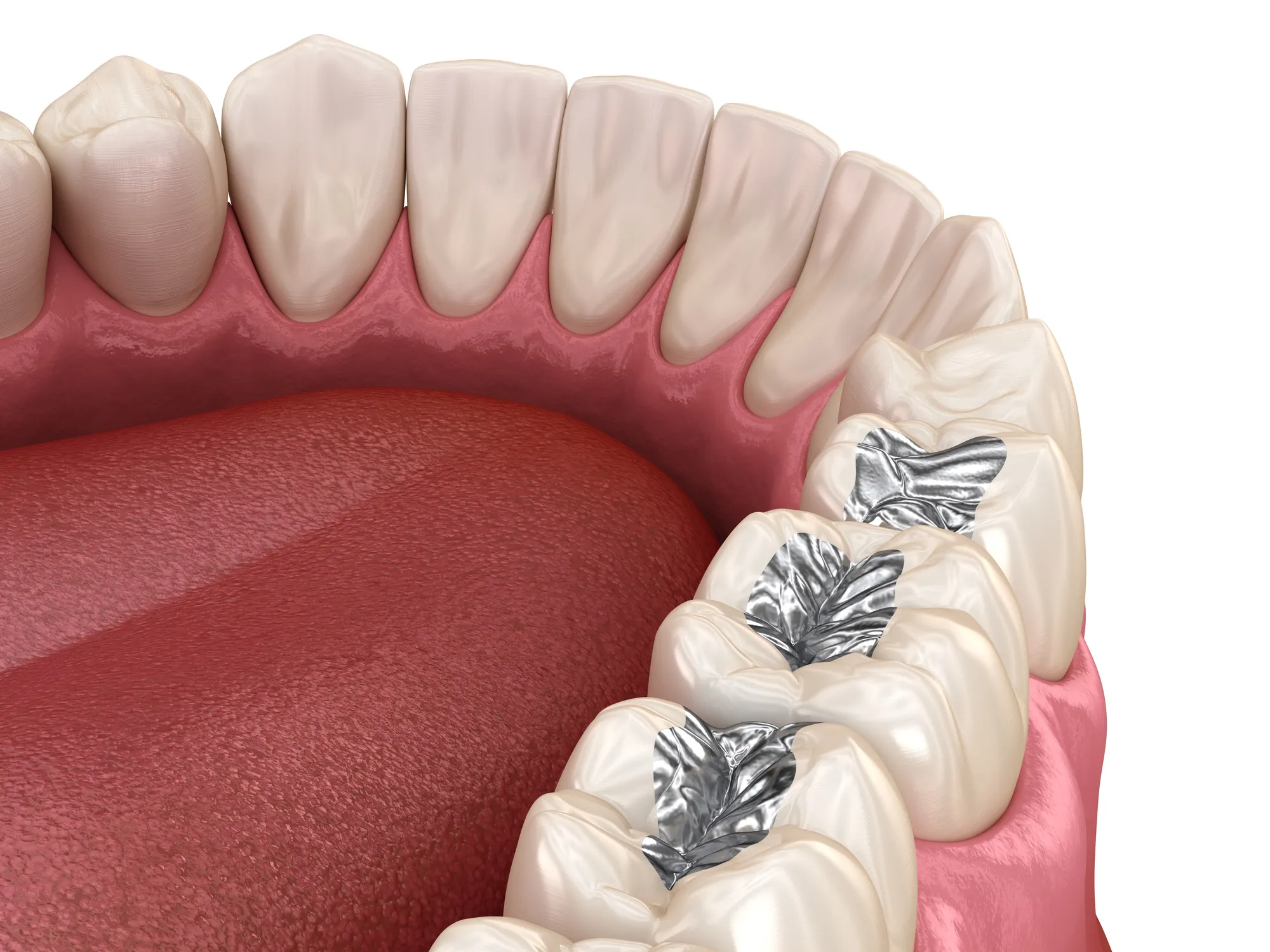 Close-up 3D illustration of upper molar teeth with silver dental fillings and a visible pink tongue and gums.