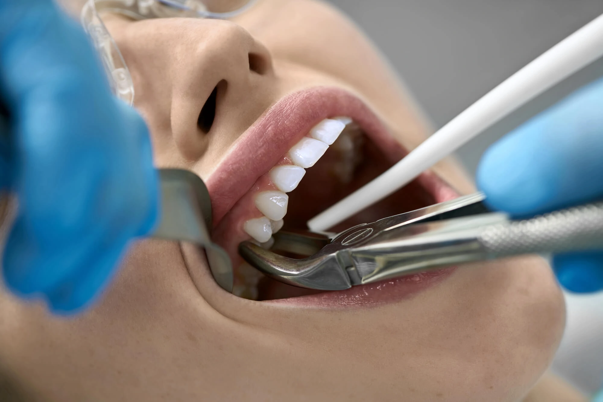 tooth extractions montgomery al