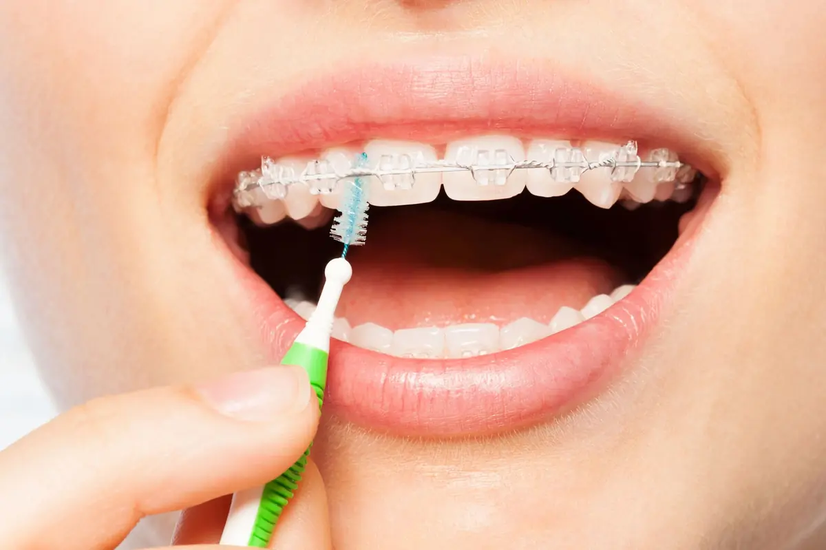 Brushing_clear_braces_in_Montgomery__AL_