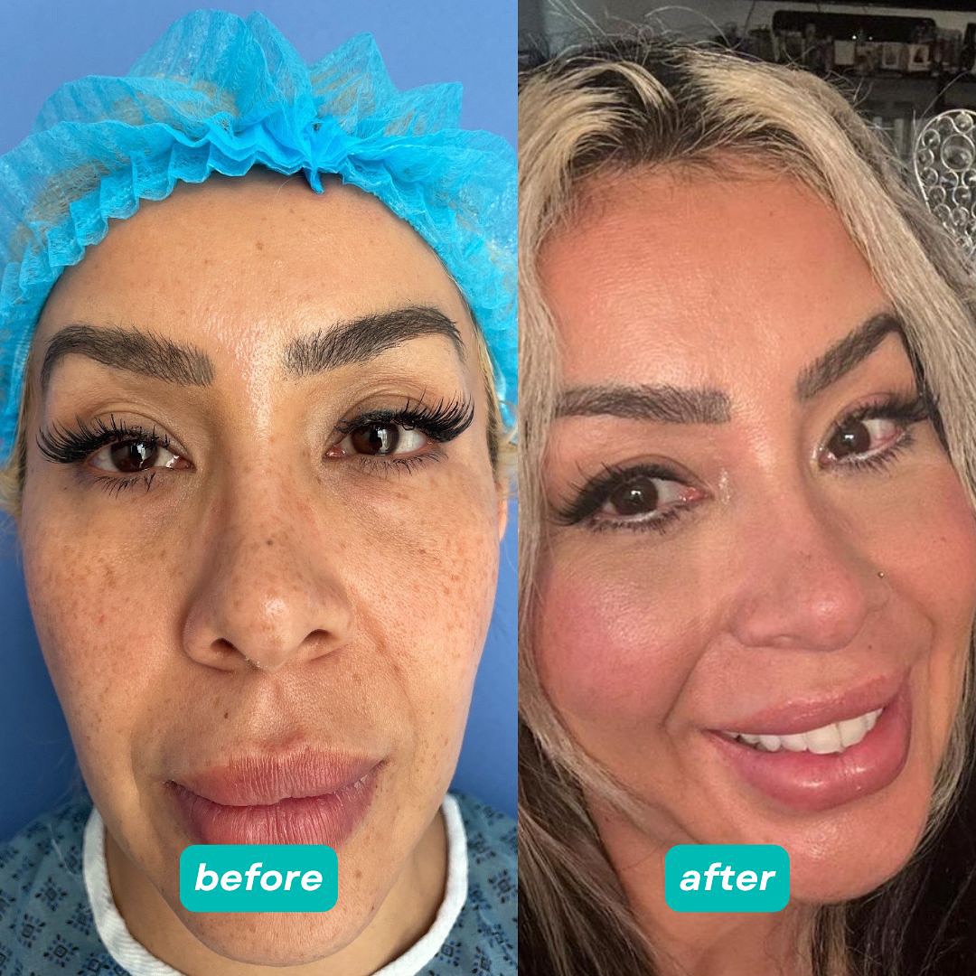results woman face lift
