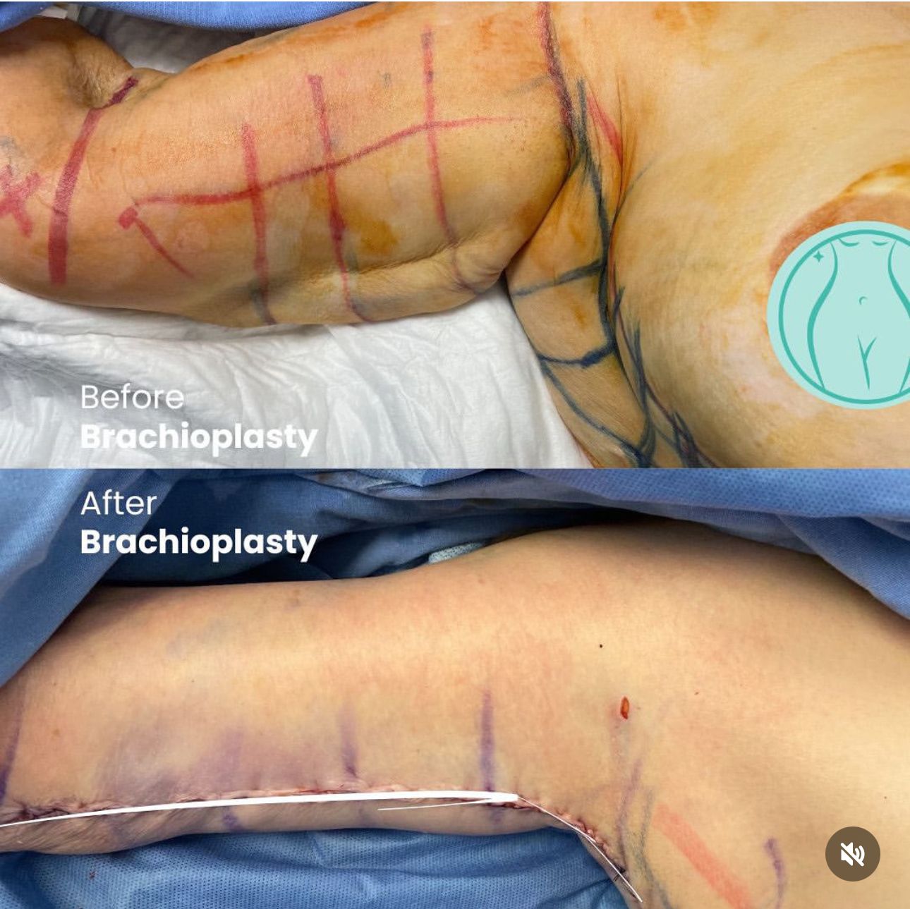results brachioplasty