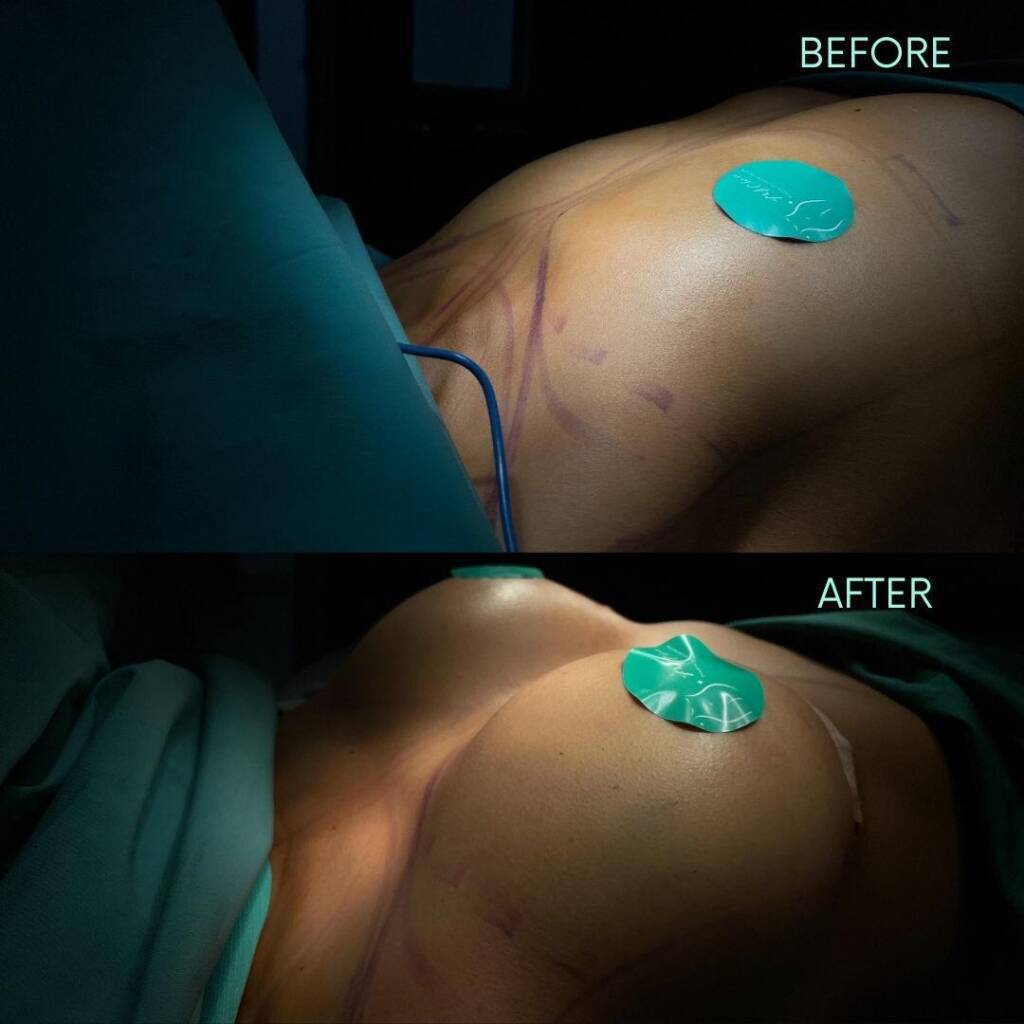 results breast augmentation