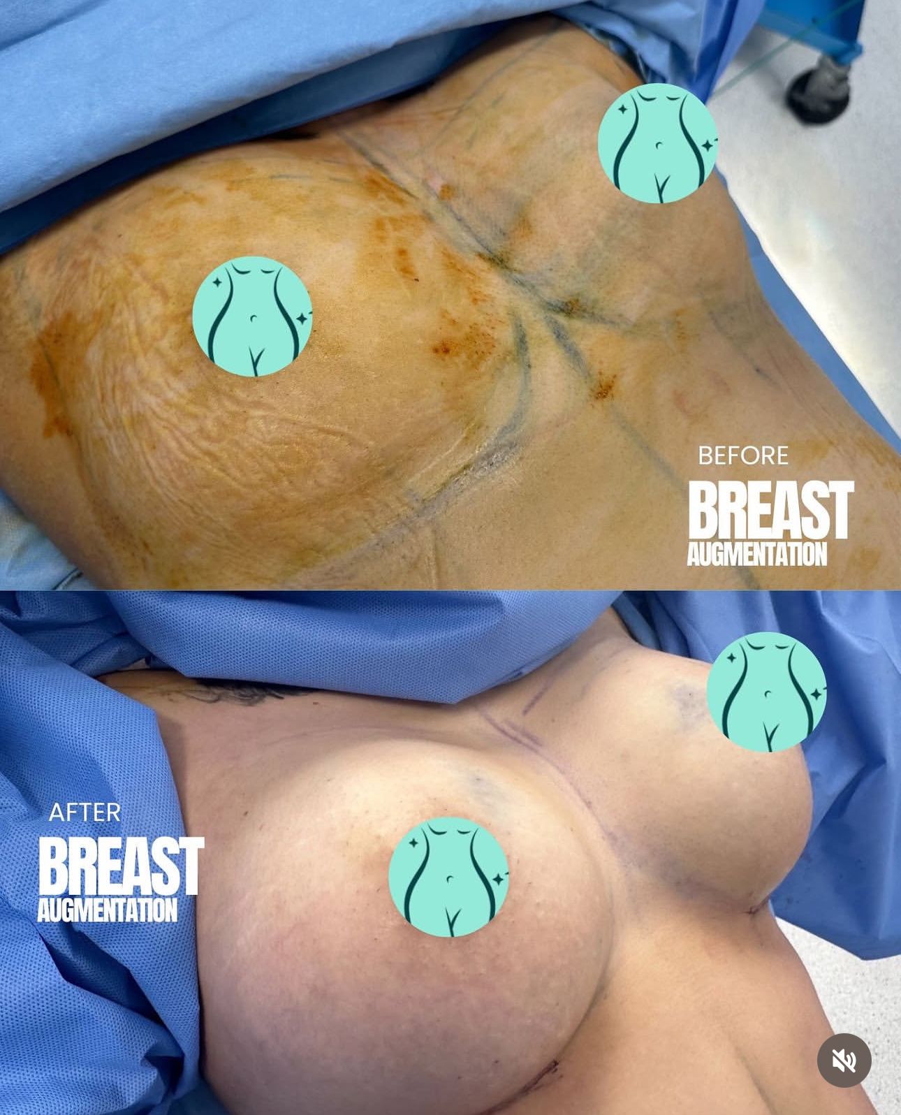 breast augmentation results from a woman
