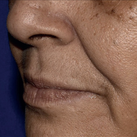 estyme-soften-baseline-img