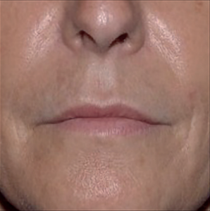 estyme-smooth-6month-img