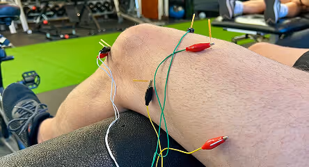 Person's knee with multiple acupuncture needles and attached wires during dry needling therapy in a clinical setting.