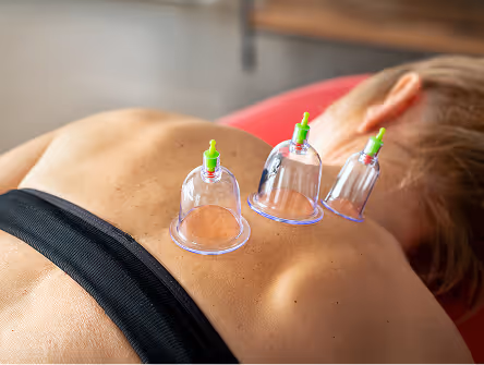 Person lying face down with three transparent cupping therapy cups placed on their upper back.