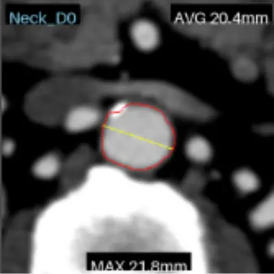 CT slice — aortic neck