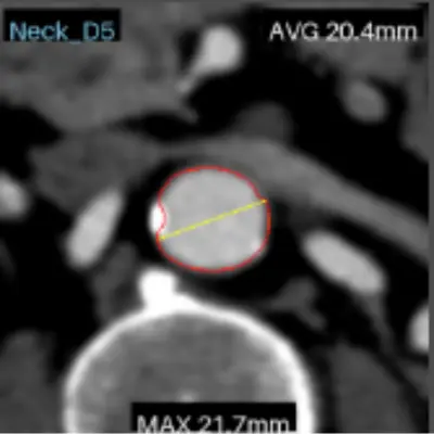 CT slice — neck D5