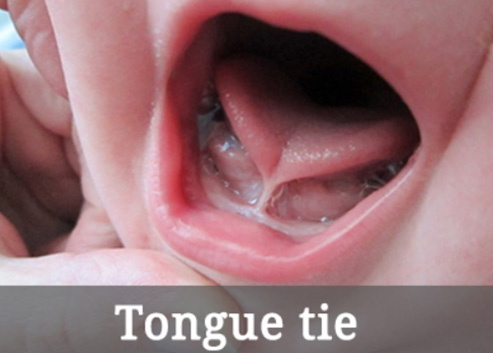 The image shows a close-up of a baby s open mouth with the tongue visible, and there is a hand holding the child s chin.
