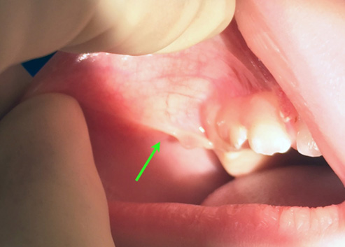 The image shows a close-up of a person s mouth with dental work in progress. A dentist is visible, using a drill to work on the teeth.