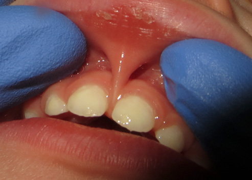 The image shows a close-up of a person s open mouth with dental tools, including a dental mirror and possibly a probe or other instrument, inside the mouth.