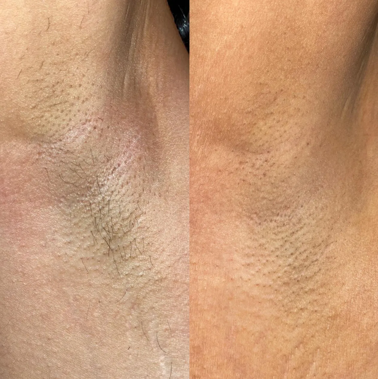 Before and after of a hair removal laser treatment