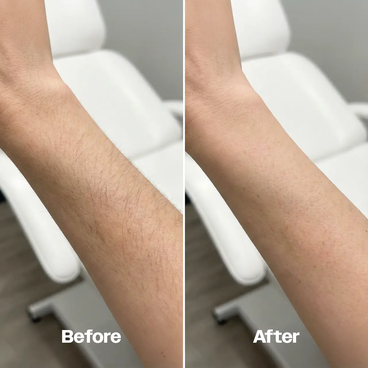 Before and after comparison of laser hair removal treatment done on someone arm
