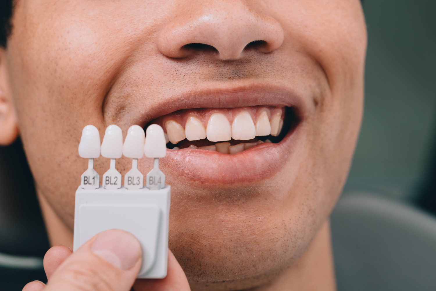 Composite Veneers: Fast, Conservative Smile Improvements