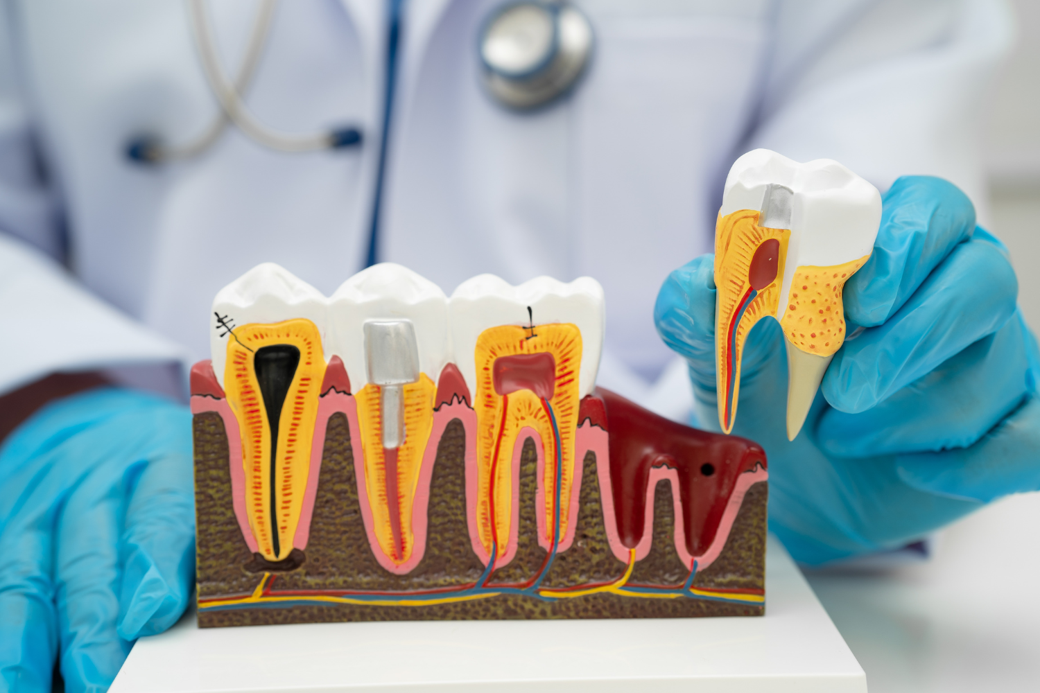 Gingivitis vs Periodontitis: Early Signs You Should Never Ignore