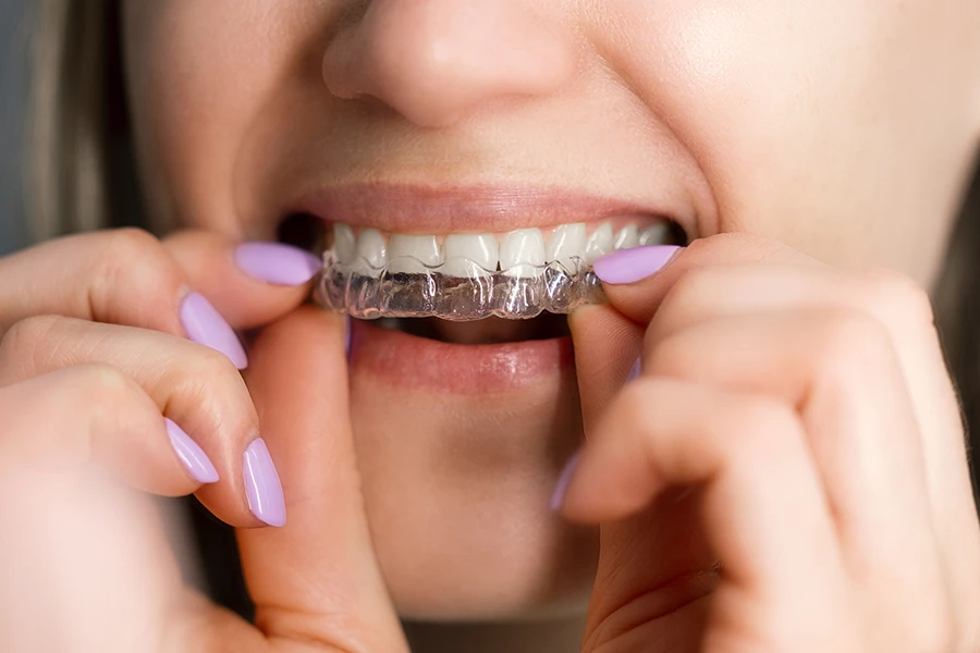 Close-up of a woman with light purple nail polish inserting a clear dental aligner over her upper teeth.