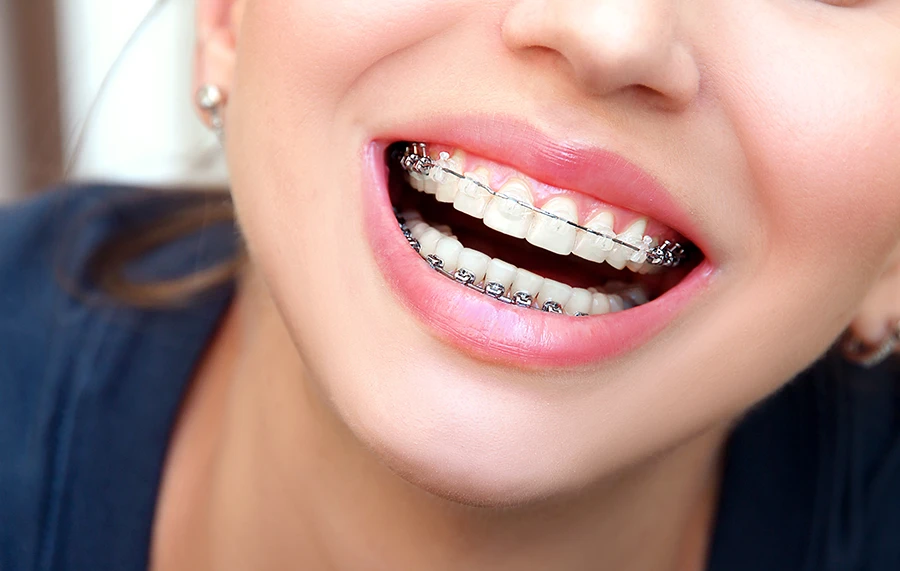 Close-up of a smiling person wearing mixed braces with clear brackets on upper teeth and metal brackets on lower teeth.